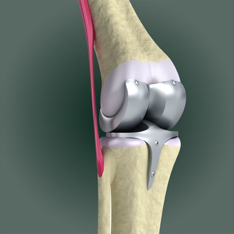protesis de rodilla_ruperez